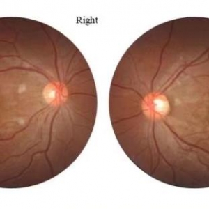 20岁女孩感染新冠3天后几近失明，确诊视网膜病变